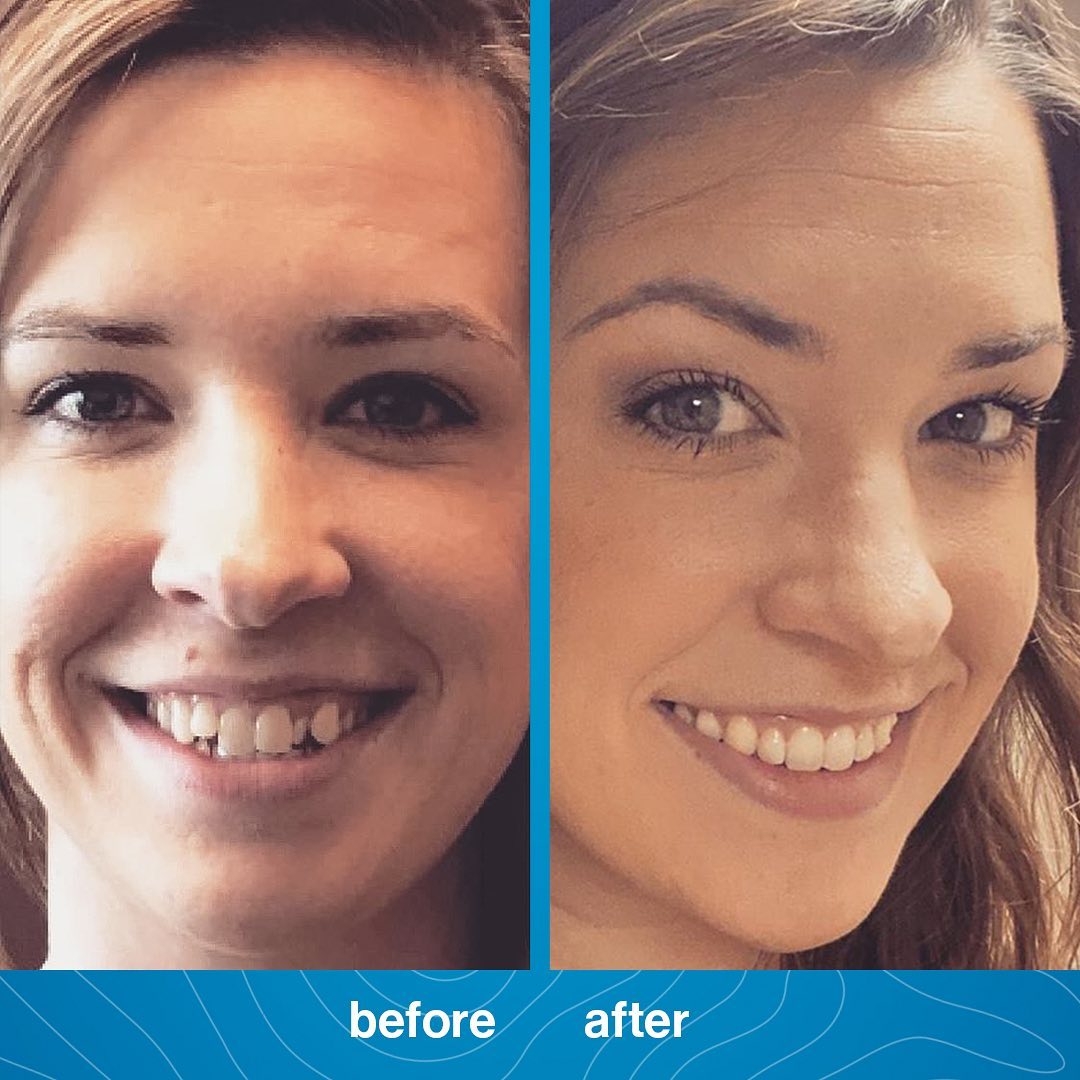 Invisalign Before and After PhotosDr. Jacquie Monroe Ortho