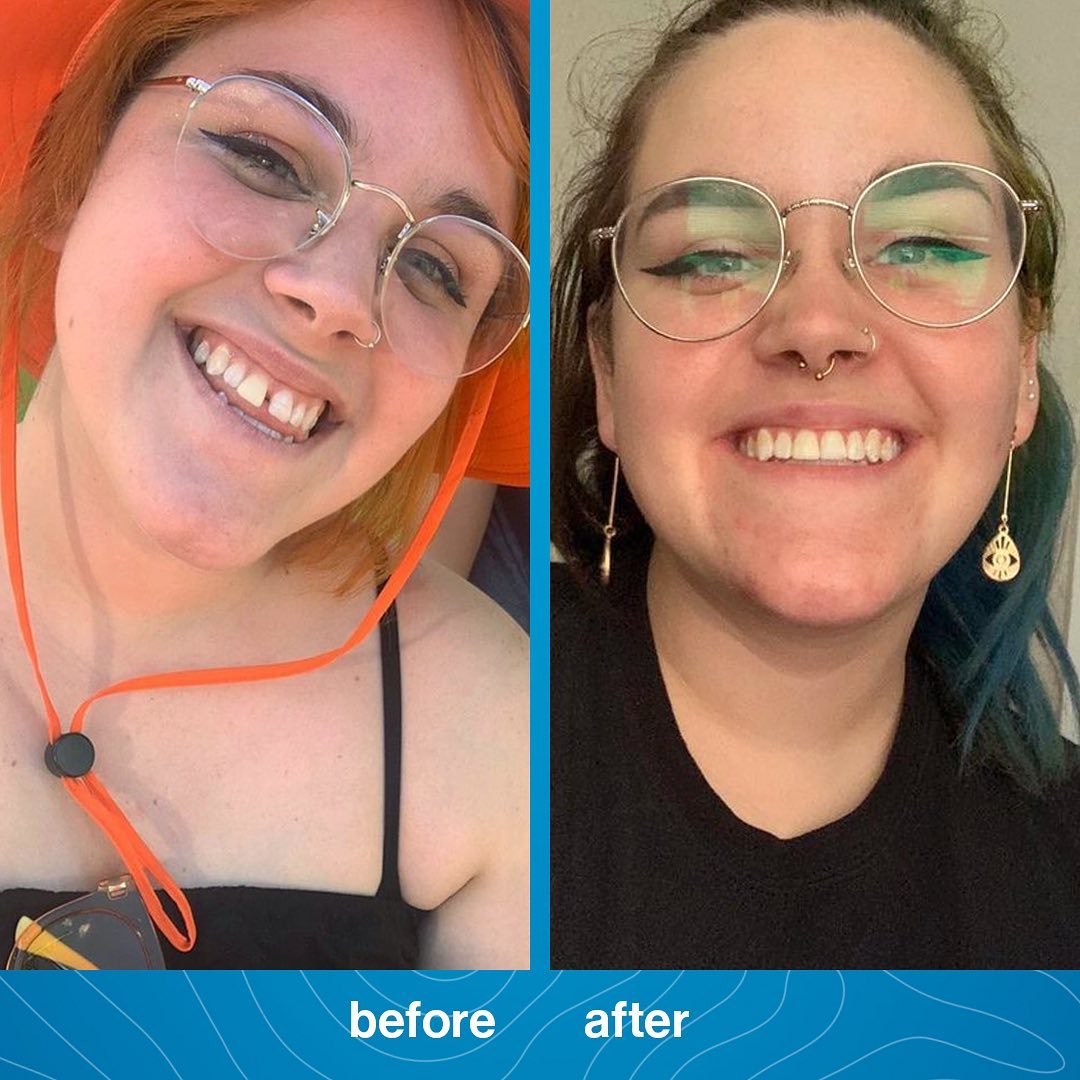 invisalign-before-and-after-treatment