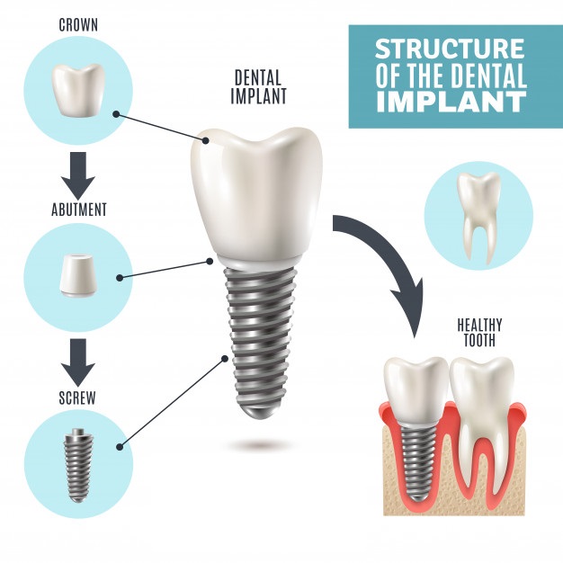 dental-implant-structure-infographic