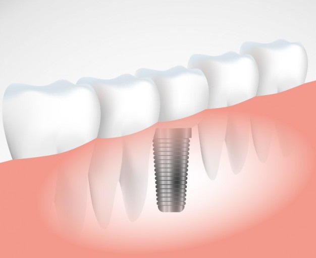 successful-dental-implant