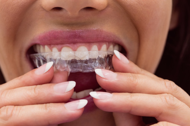 woman-wearing-invisalign-braces