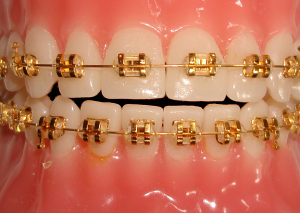 gold-braces-man