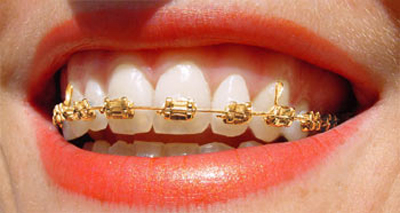 gold-braces-woman