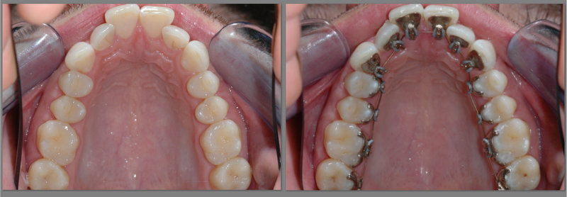 lingual-braces-before-after-image