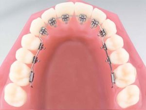 lingual-braces-illustration