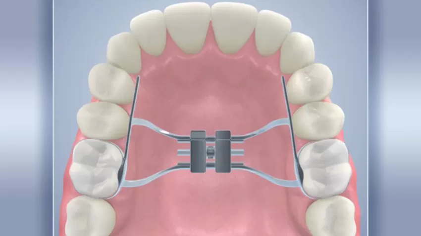 Rapid-Palatal-Expander-illustration