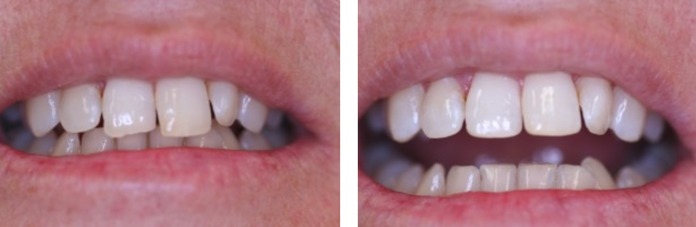 TOOTH RECONTOURING