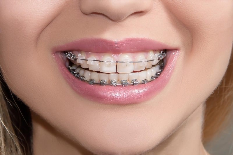 What types of braces are there?