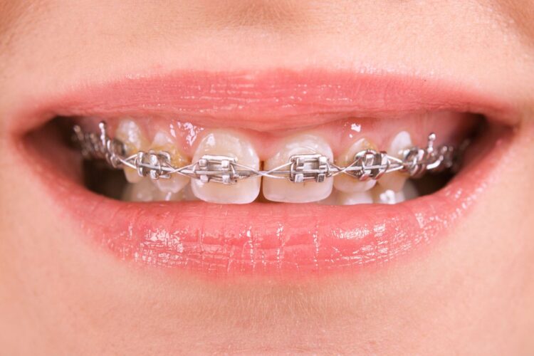 Train Track Braces for Adults and Children Types & Costs