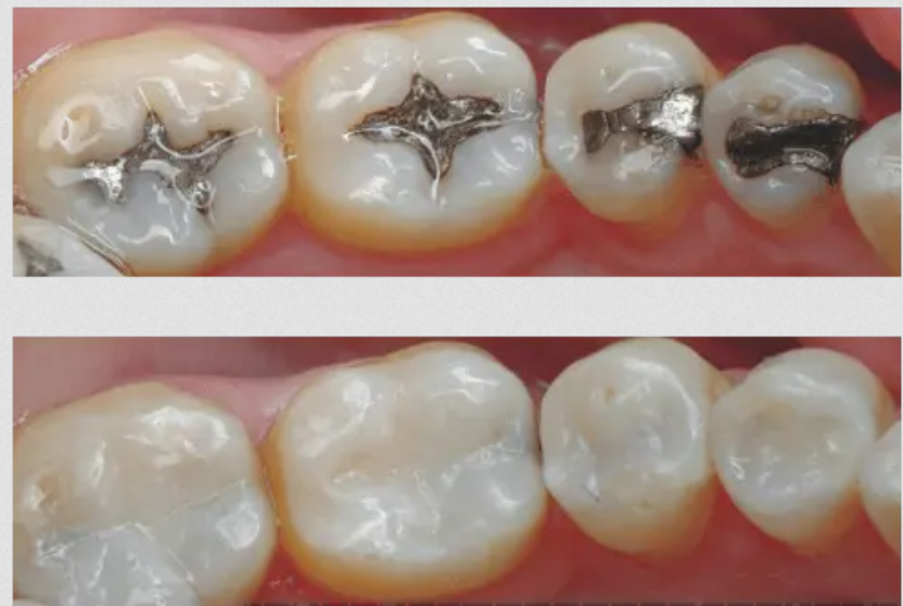 Dental Cavities with White Composite Filling-before-after-pciture