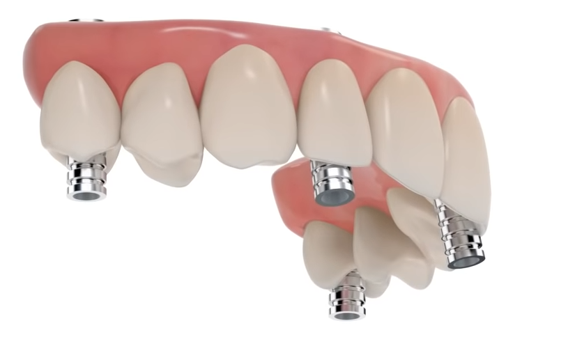 All on 4 Dental Implants in London Treatment Cost