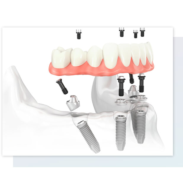 all-on-four-dental-implants