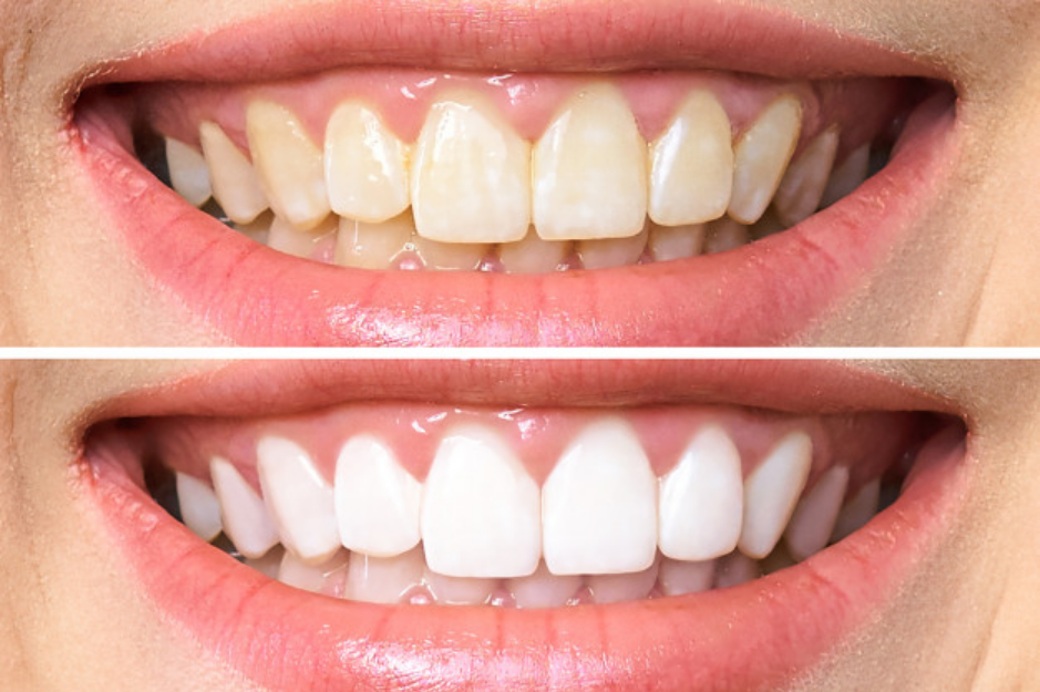 teeth-whitening-before-and-after-picture