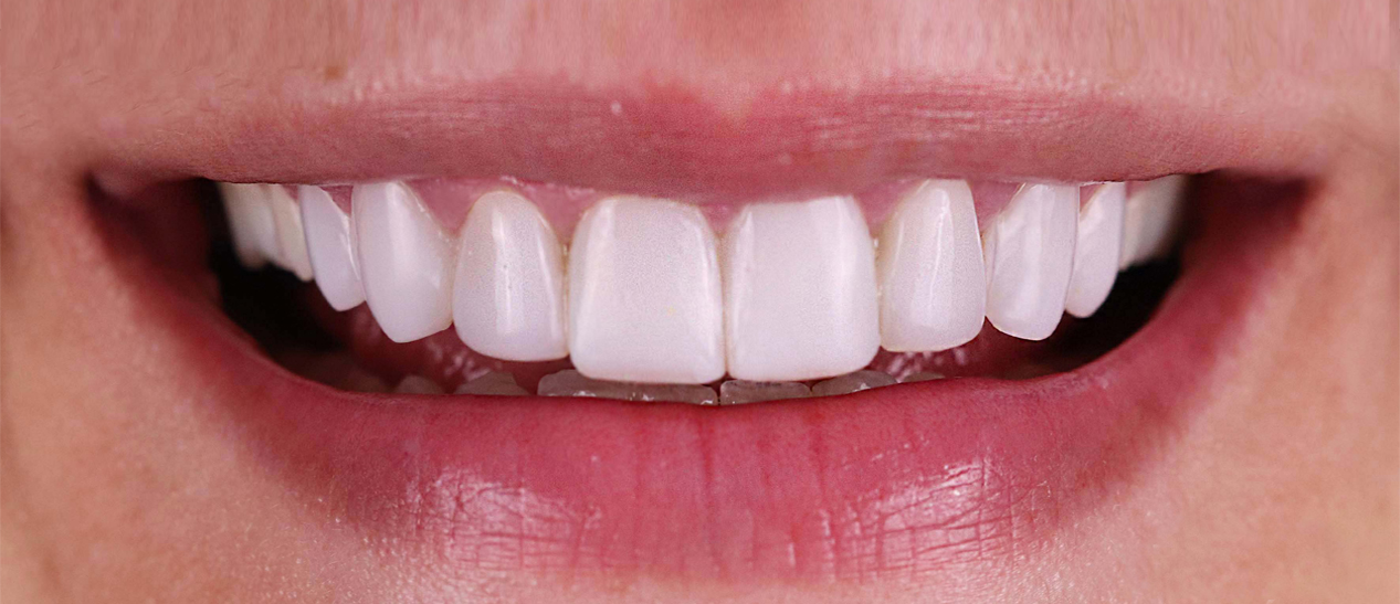 Emax Veneers London Enhance Dental Aesthetics with Emax Veneers