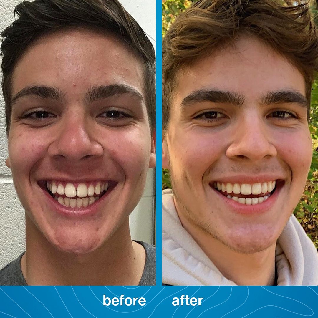 Invisalign before and after 2 Beyond Dental