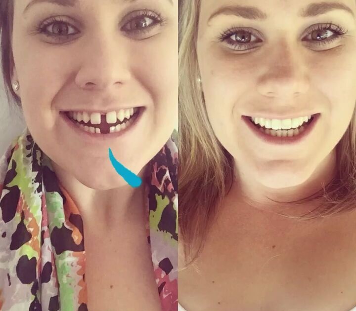 Invisalign Birmingham's No. 1 Provider of Invisalign Braces