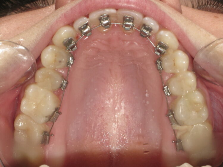 How much does Lingual braces cost UK? Lingual cost London