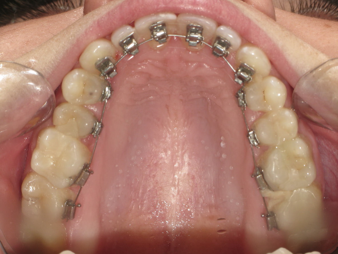 lingual-braces-inside-mouth-picture