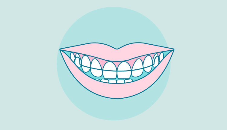 dental-retainers-illustration