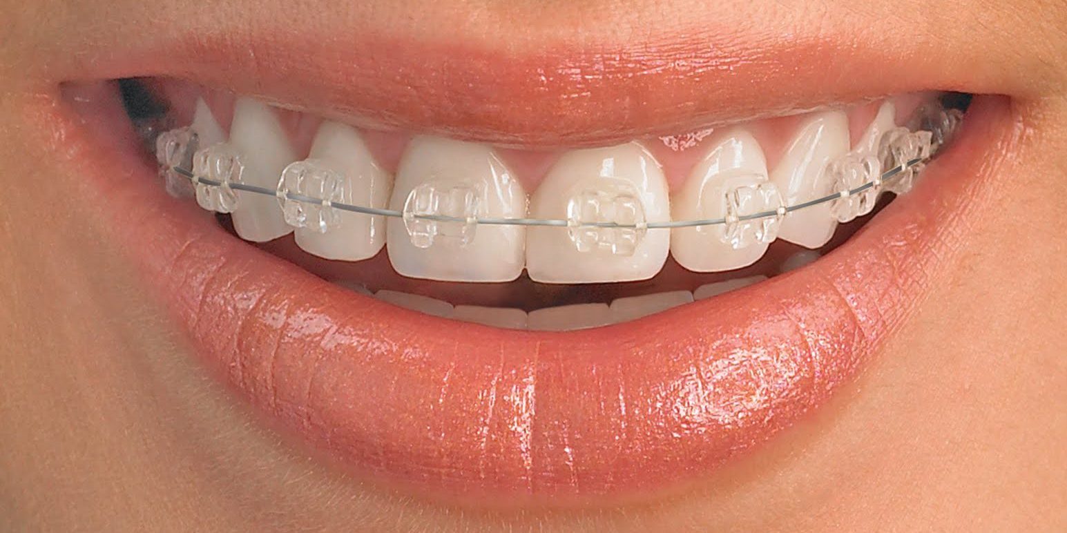 sapphire-Ceramic-braces