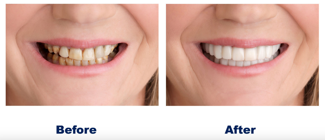 snap-on-smile-before-after-picture