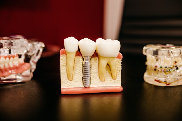 dental-implant-plastic-model