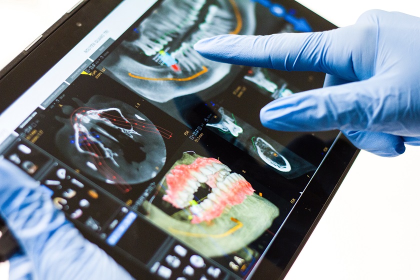 dental-implant-xray