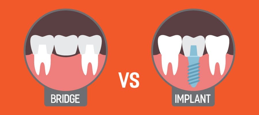 dental_implant_vs_dental_bridge