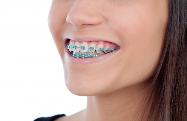 green-color-dental-braces