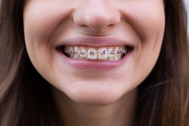 pink-colored-dental-braces