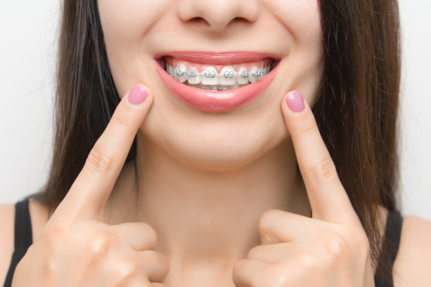 silver-colored-braces