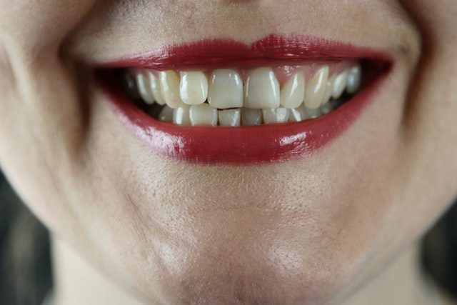 white-teeth-woman