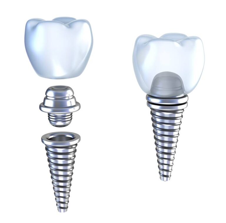 What is Dental Implant Abutment? Types and Cost