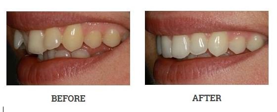 inman-aligners-before-and-after